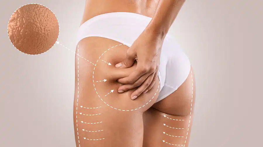 A white woman with cellulite on her buttocks.